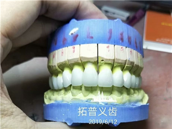 High Esthetics Zirconia Dental Lab Crowns Bridge With Layered Porcelain